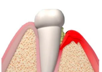Почему зуб болит после лечения