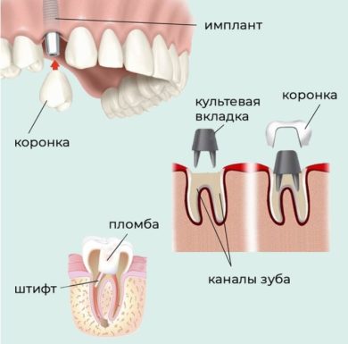 Роль материалов для восстановления культи в сохранении структуры зуба